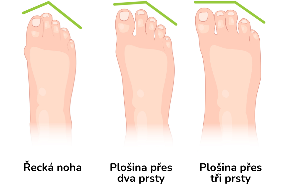 Typy chodidel - řecká,